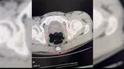 Batman girişinde durdurulan otobüste midesinden uyuşturucu çıkan yolcu tutuklandı