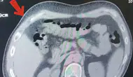Tatvan yolunda midesinden 608 gram uyuşturucu çıktı