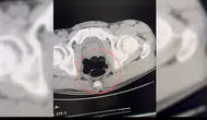 Batman girişinde durdurulan otobüste midesinden uyuşturucu çıkan yolcu tutuklandı
