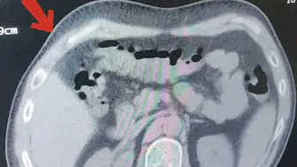 Tatvan yolunda midesinden 608 gram uyuşturucu çıktı