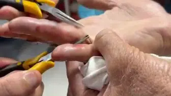 Batman'da parmağına yüzük sıkışan yaşlı adam hastanede rahat bir nefes aldı