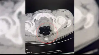 Batman girişinde durdurulan otobüste midesinden uyuşturucu çıkan yolcu tutuklandı