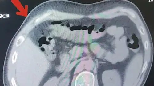 Tatvan yolunda midesinden 608 gram uyuşturucu çıktı