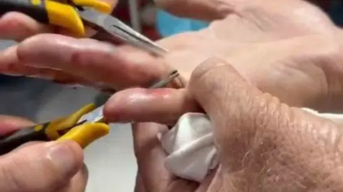 Batman'da parmağına yüzük sıkışan yaşlı adam hastanede rahat bir nefes aldı
