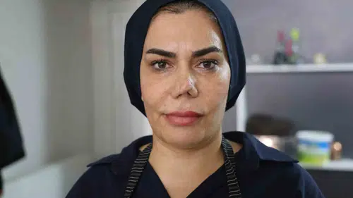 Elazığlı kadının burnu dört ameliyat sonrası tanınmaz hale geldi