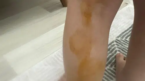Şanlıurfa Halfeti'de küçük çocuk sokak köpeğinin saldırısı sonucu yaralandı