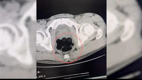 Batman girişinde durdurulan otobüste midesinden uyuşturucu çıkan yolcu tutuklandı