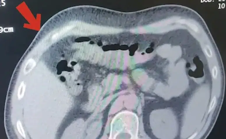 Tatvan yolunda midesinden 608 gram uyuşturucu çıktı