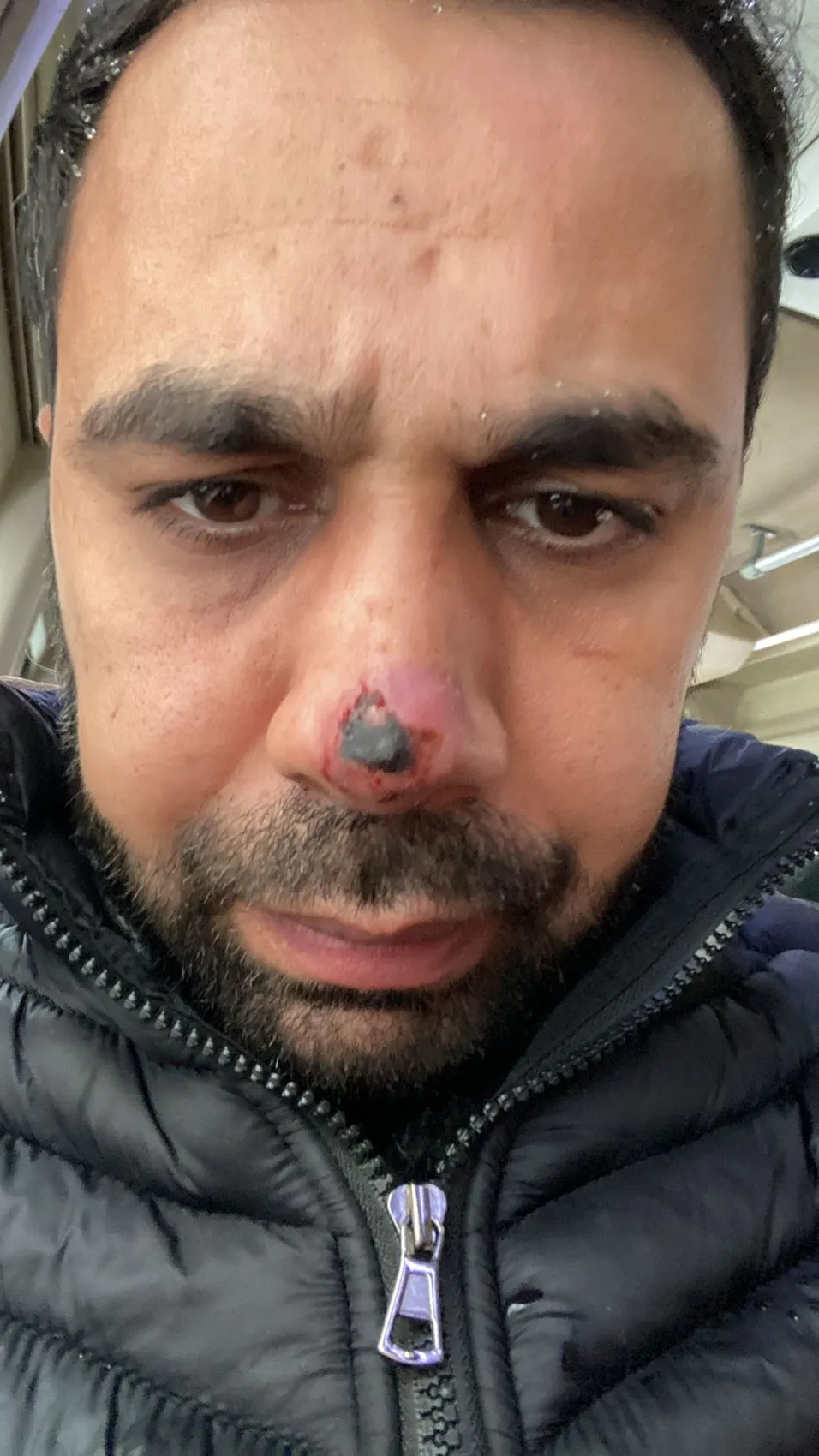 Estetik ameliyat sonrası burnunda oluşan iz için hastaneye dava açtı