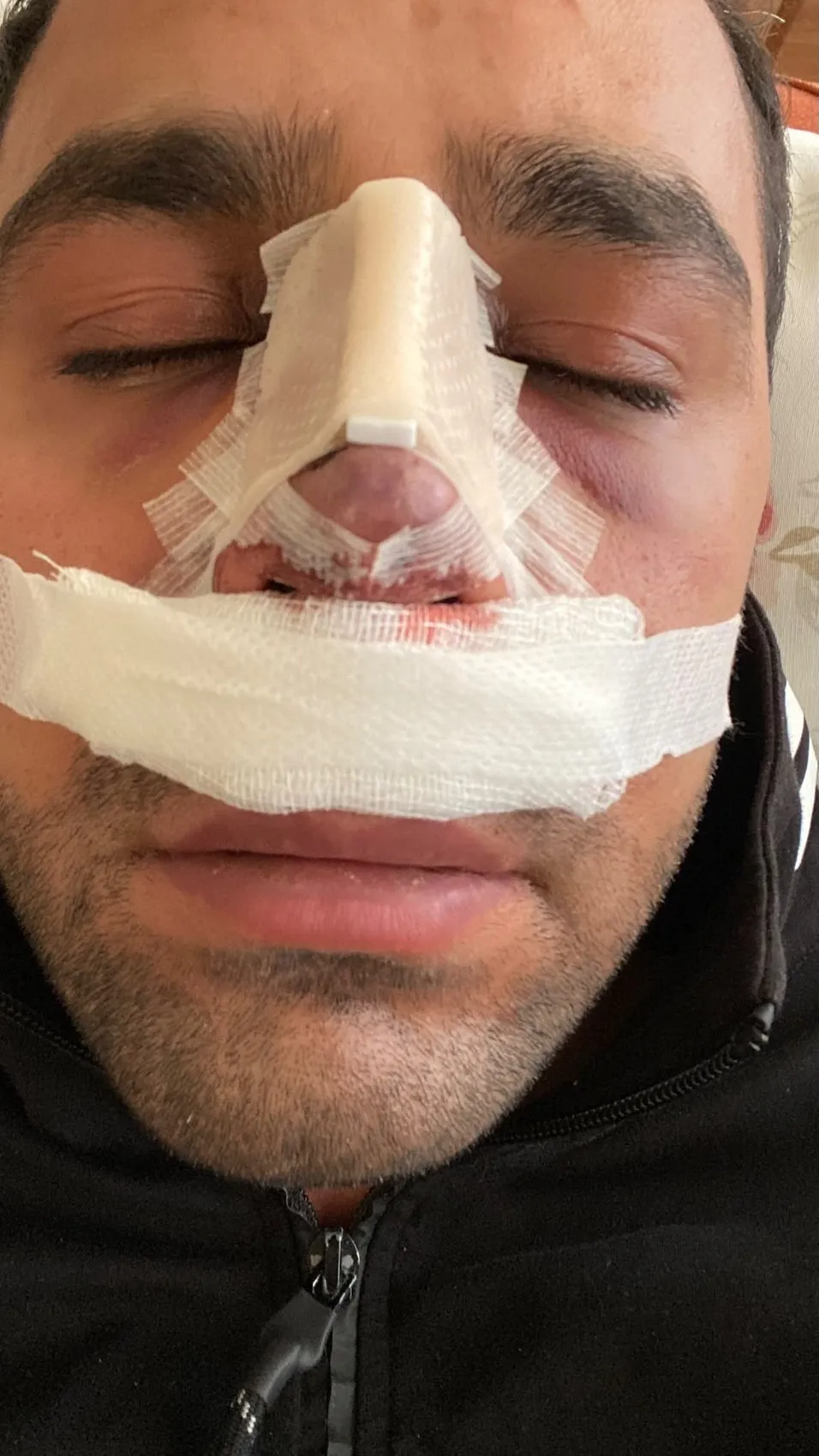 Estetik ameliyat sonrası burnunda oluşan iz için hastaneye dava açtı