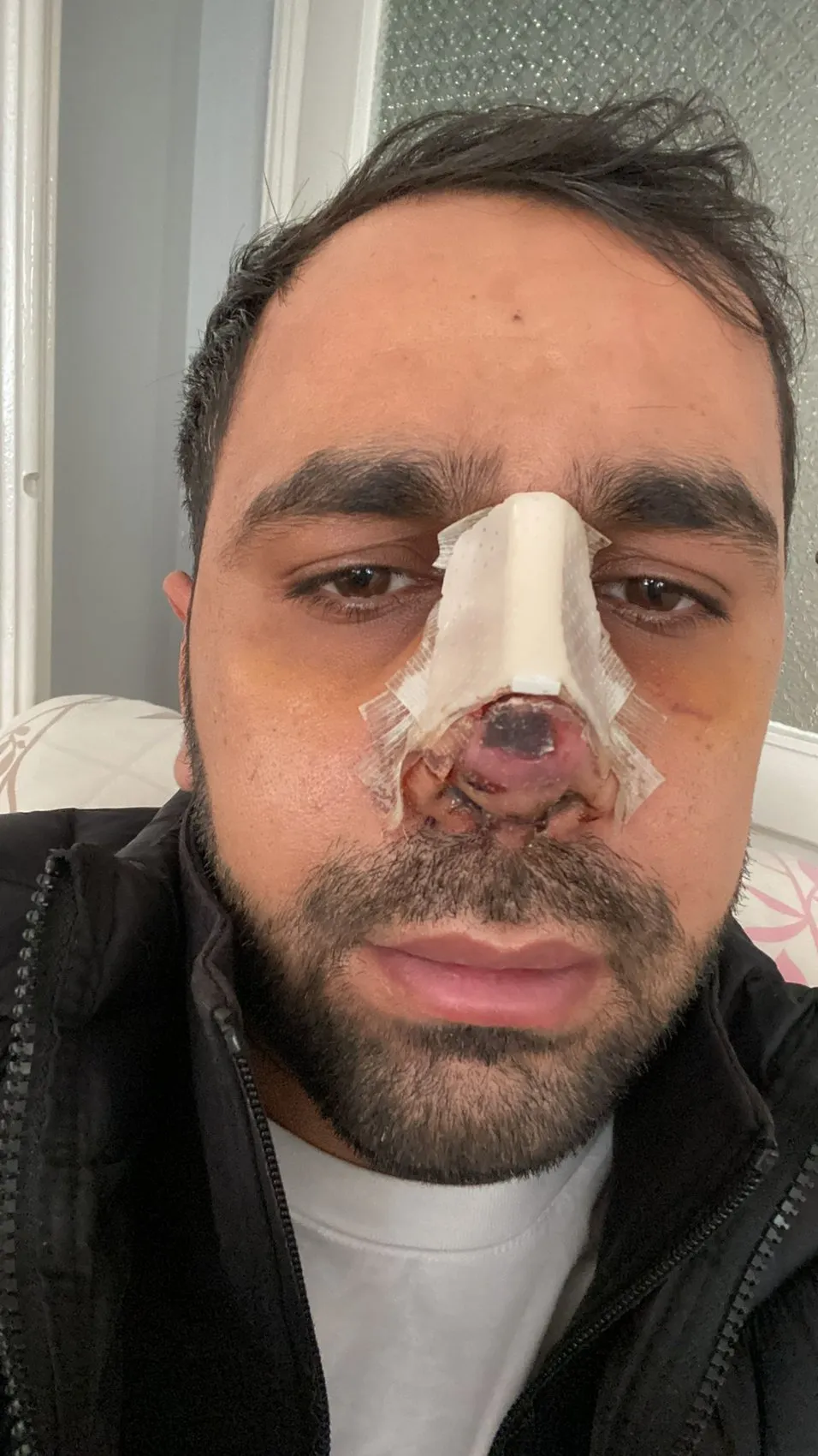 Estetik ameliyat sonrası burnunda oluşan iz için hastaneye dava açtı